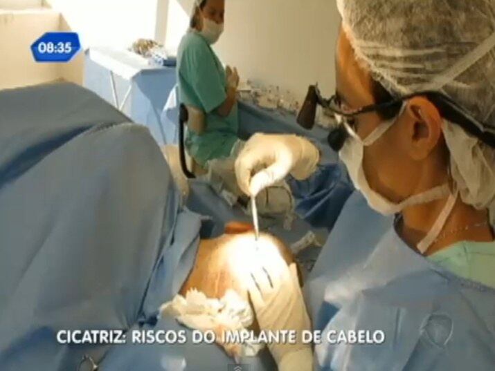 O paciente recebe uma anestesia local, e fica acordado
+ Implante capilar: conheça os riscos do procedimento
