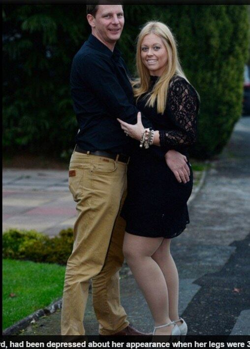 Apesar de ter perdido 63 kg após colocar banda gástrica no
estômago para emagrecer, a mulher nunca conseguiu perder peso nas pernas. Hoje, ela pesa 83
kg, segundo a publicação. 