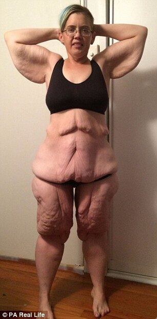 Três meses antes da operação, ela foi chamada para uma consulta e lhe foi dito que precisaria perder cerca de 20 kg para poder realizar a cirurgia. Então, ela basicamente parou de comer: só se alimentava de vegetais e shakes. Em abril de 2010, ela passou pela cirurgia. O tempo de recuperação foi rápido: em menos de uma semana, ela perdeu 5 kg. E em um mês já tinha perdido cerca de 18 kg