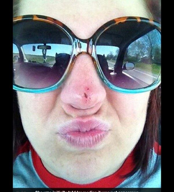 Ela teve de fazer três grandes cirurgias plásticas, e outras
pequenas reconstruções, para voltar a ter o rosto normal. Apesar de o câncer
agora estar em remissão, os médicos a avisaram que ele pode retornar