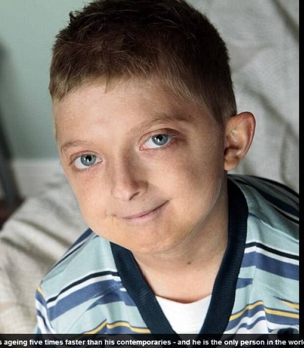 

Harry Crowther, 15 anos de idade, de Mirfield, Inglaterra, parece que tem
cerca de 70 anos de idade. Apesar da condição, ele conta que não se sente “para
baixo”.

— Poderia passar minha vida me perguntando: 'Por que eu?' Mas qual é o ponto? Não há nada que eu possa fazer sobre isso além de olhar
para o futuro e aproveitar cada dia para aprender coisas novas

