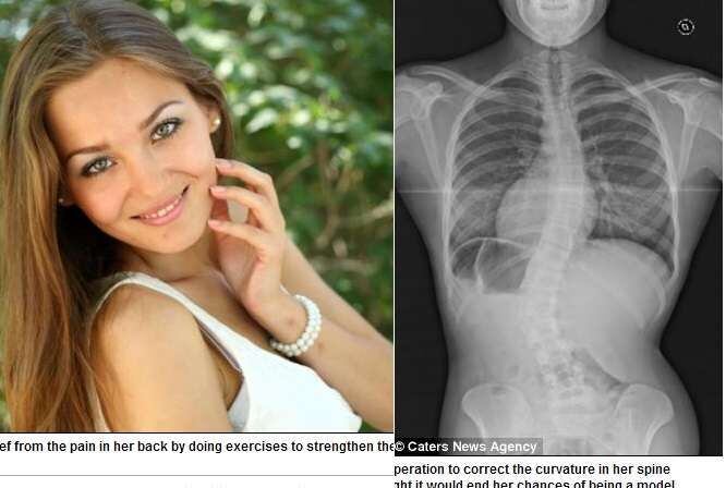 A
adolescente Leanne Roberts, de 18 anos, de Yorkshire, na Inglaterra, tinha medo
de ficar corcunda por causa de uma deformação em sua coluna. Aos 16 anos, a
jovem foi diagnosticada com escoliose grave — uma doença que provoca uma
curvatura excessiva da espinha. Essa condição afeta cerca de 4% da população.
Quando não tratada, pode trazer problemas no coração e pulmões. Mas,
depois de passar por uma cirurgia, o problema foi resolvido e a adolescente
pode realizar o sonho de se tornar modelo
Mau uso do travesseiro pode prejudicar o sono e coluna; veja mitos e verdades