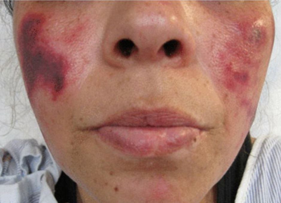 A cocaína inflama essas células sanguíneas, que deixam
marcas vermelhas impressionantes na pele, e depois começam a escurecer. Tudo
acontece por causa da substância Levamisole