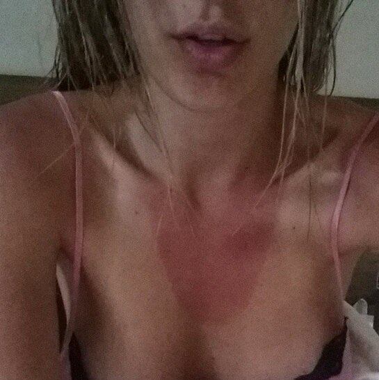 5) Quando ela mostrou o bronzeado nada sexy que pegou por causa de uma reportagem que fez debaixo do sol