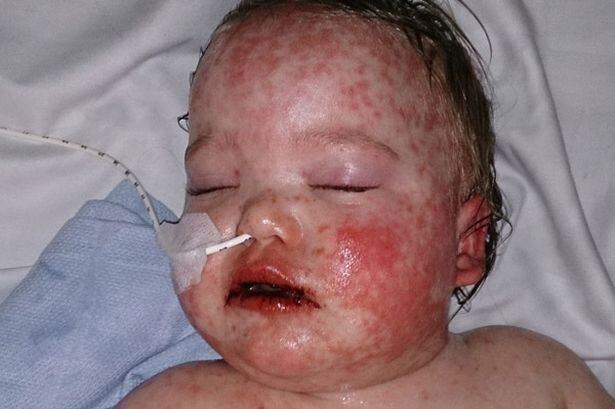 
Danielle conta que ficou horrorizada quanto a pele do filho começou a empolar. 

—  Seus lábios ficaram pretos e uma erupção vermelha cobria todo o seu corpo. Não tínhamos ideia do que estava acontecendo com ele, mas nós sabíamos que era uma ameaça à vida. A boca dele estava coberta de sangue, foi assustador
