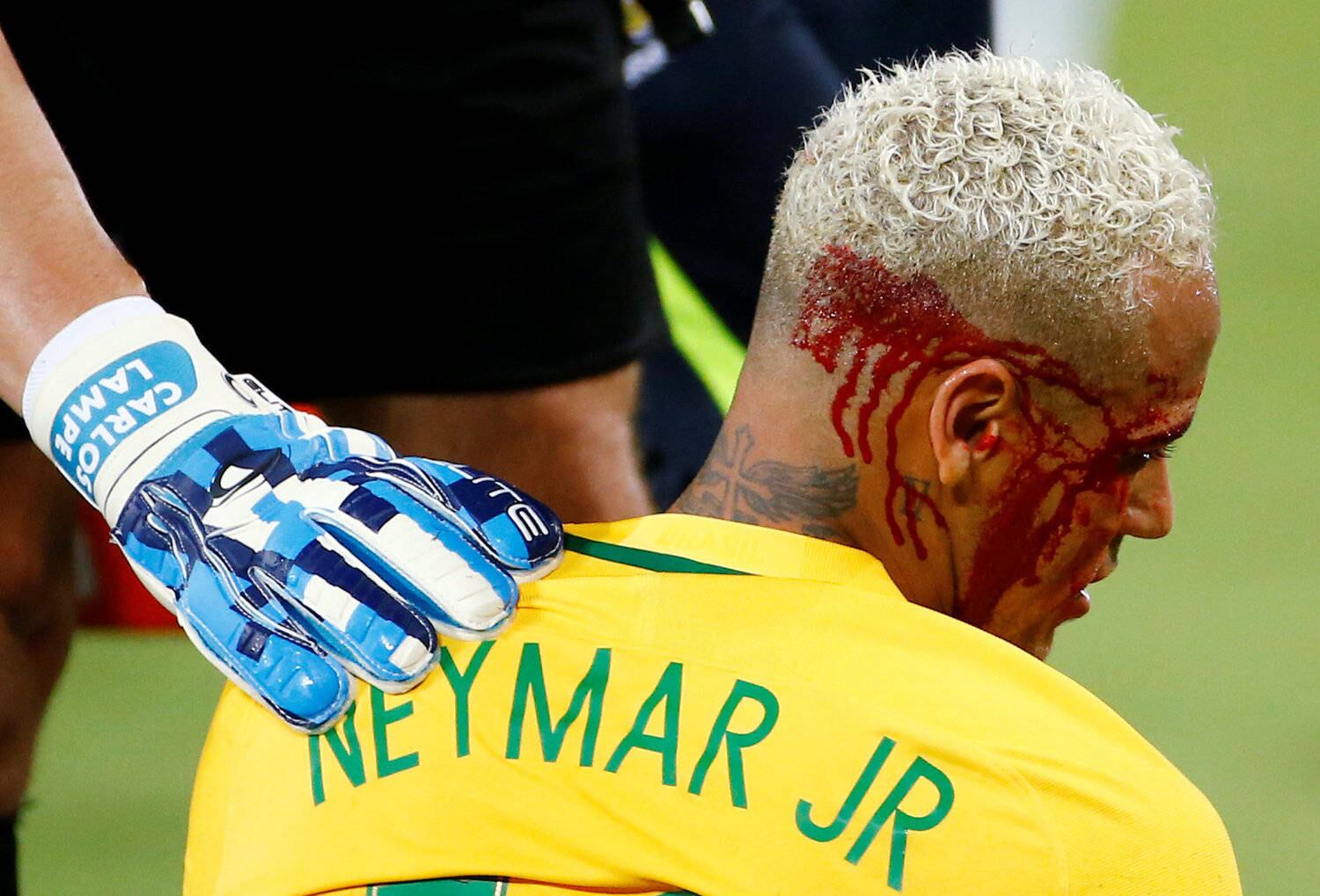 Neymar deixou o campo sangrando na última quinta-feira