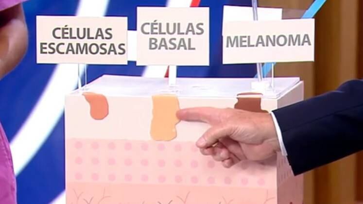 Existem três tipos de câncer de pele: os de célula escamosa, células basal e o melanoma que pode matar. Os fatores de risco para esse tipo de tumor são: exposição solar, predisposição genética, cor de pele, olhos e cabelos claros, e sistema imune debilitado