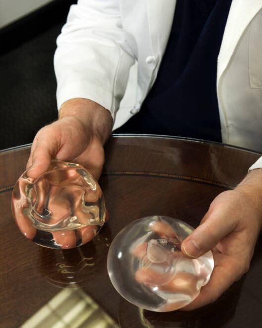 Rompimento da prótese

Muitas mulheres têm receio de que o implante exploda dentro do seu corpo, mas o cirurgião plástico André Colaneri, garante que está situação é muito difícil de acontecer.

― Os implantes são feitos de um gel coeso e as cápsulas são bem resistentes. É claro que com o tempo, as próteses vão sofrendo desgastes e ficam mais suscetíveis ao rompimento.


Caso isso ocorra, o médico explica que a chance de o gel se espalhar pelo corpo é mínima, mesmo assim a paciente precisa se submeter a novo procedimento para a troca da prótese