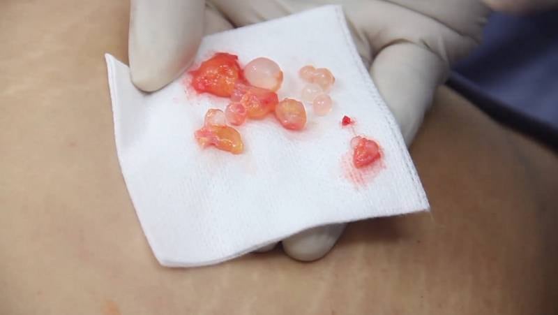 Silicone industrial infiltra nos tecidos e se transforma em bolinhas