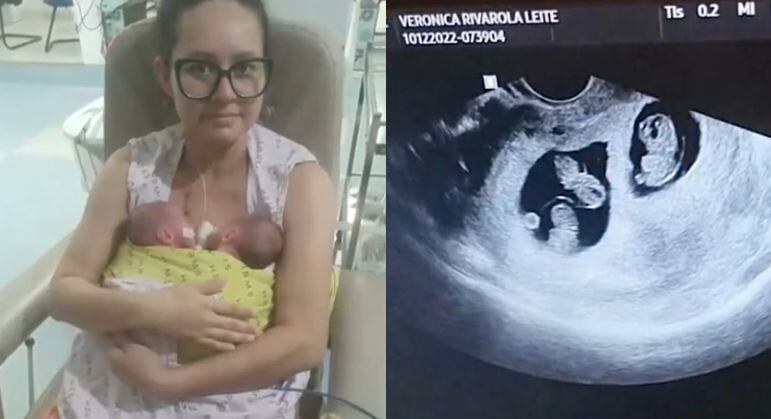 Eloá, Maitê e Gabriel nasceram prematuros com 32 semanas