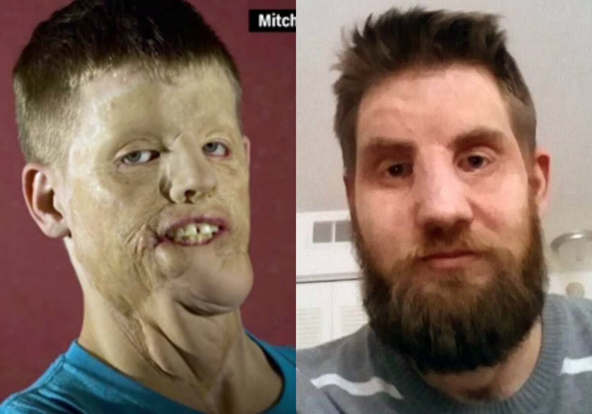 O norte-americano Mitch Hunter tinha apenas 21 anos quando o carro em que estava colidiu com um poste eléctrico de 10.000 volts

ATENÇÃO: ALGUMAS IMAGENS A SEGUIR SÃO FORTES!