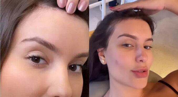 Frontoplastia 
A influenciadora Thais Braz virou assunto ao mostrar detalhes da cirurgia que fez com o objetivo de diminuir o tamanho da testa. Ela retirou cerca de 2 cm da região, no procedimento que consiste em realizar um corte na região do couro cabeludo e "empurrar" a pele para baixo, fazendo assim a testa ficar menor