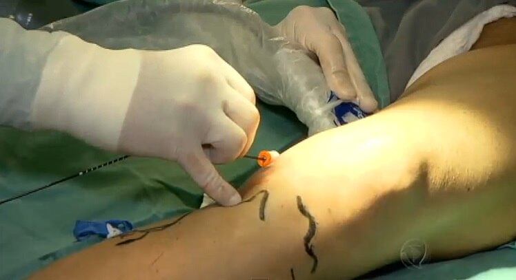 Esta terapia causa uma certa dor e desconforto, não só pela picada da agulha, mas pela entrada do medicamento na veia, mas a maioria dos pacientes tolera bem esta dor

No R7 Play, você pode assistir ao Fala Brasil na íntegra! Clique e experimente de graça!

