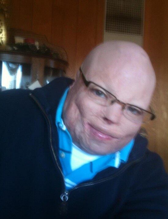 Há dez anos, Brad Hearon, 30 anos, do Colorado, Estados Unidos era viciado em droga. Mas
um trágico acidente que queimou 80% de seu corpo transformou a sua vida