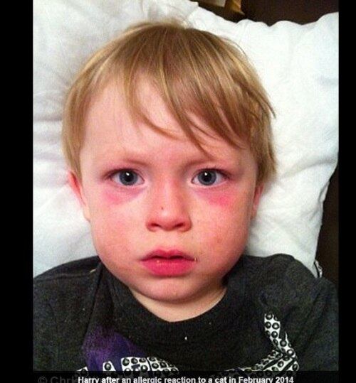 

De acordo com os médicos, a urticária possui diferentes
tipos de alergia, e a que Harry foi diagnosticado é a mais rara e mais
perigosa.

A doença pode acontecer em qualquer idade e, segundo a mãe,
Lisa, Harry apresentou os primeiros sintomas aos três meses de idade.



— A primeira vez que ele aparentou ter problemas foi quando
ele acordou a casa inteira chorando no berço, todo vermelho e com marcas de
alergia no corpo. Ficamos desesperados. Fomos correndo para o médico, mas a
alergia foi passando conforme íamos para o consultório

