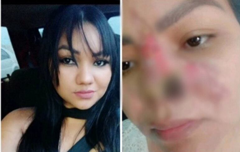 A alectomia é uma cirurgia para afinar o nariz, realizada por meio da redução dos cantos inferiores da região — conhecidos como abas nasais. O procedimento é voltado para pessoas que sentem algum tipo de insegurança com a largura da base do nariz. Ela é uma parte da cirurgia de rinoplastia, porém se popularizou de forma individual porque é feita com anestesia local e de forma mais "simples", sem interferir nas outras áreas do nariz, como a ponta e a região do osso nasal