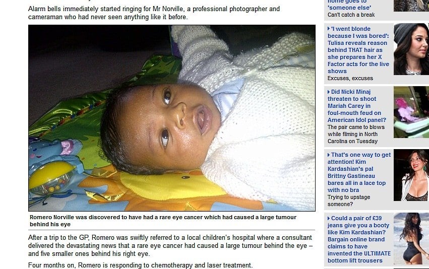 Após o tratamento, tumor no olho esquerdo diminuiu em um terço e os menores sumiram