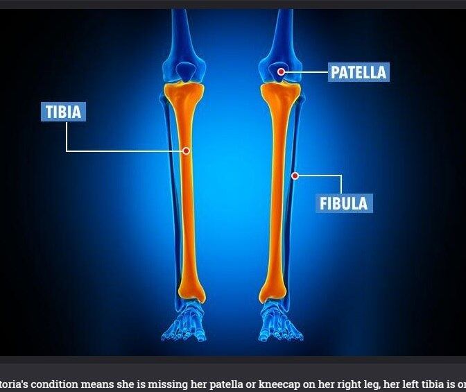 Para isso necessitam de cerca de R$ 1,2 milhão para cobrir
os gastos. O valor pagaria três operações e também a estadia por 12 meses nos
EUA