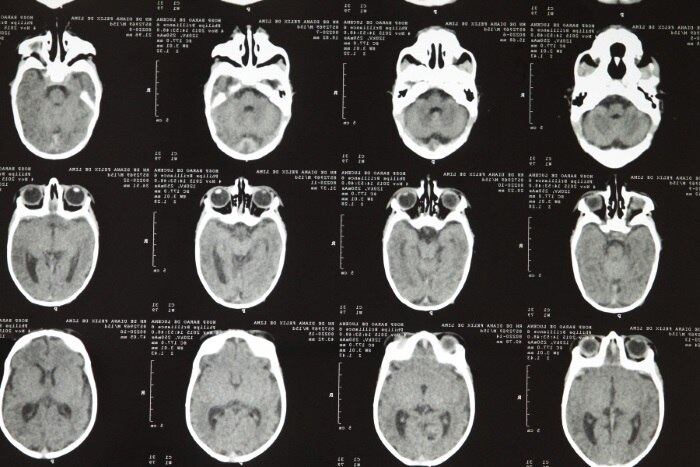 A microcefalia pode levar a óbito ou deixar sequelas?
Cerca de 90% das microcefalias estão associadas com retardo mental, exceto nas de origem familiar, que podem ter o desenvolvimento normal. O tipo e o nível de gravidade da sequela vão variar caso a caso, mas tratamentos realizados desde os primeiros anos de vida podem melhorar o desenvolvimento e a qualidade de vida