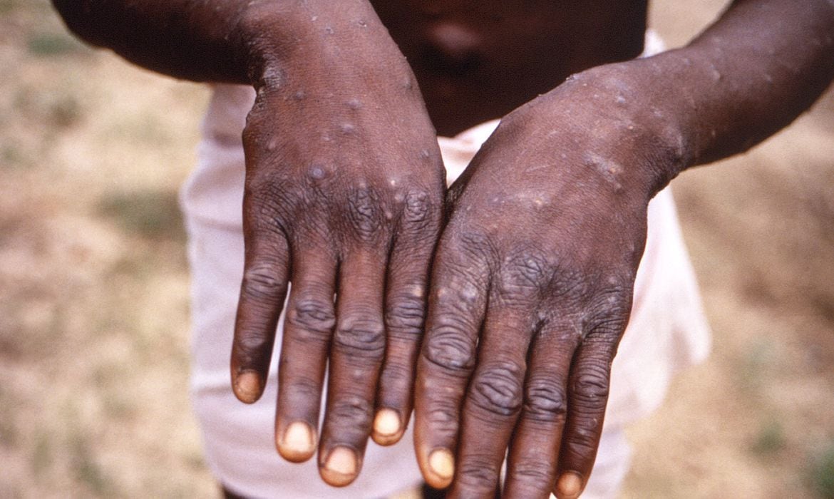 Um dos sintomas da doença são erupções no corpo, além de febre, dor de cabeça e muscular