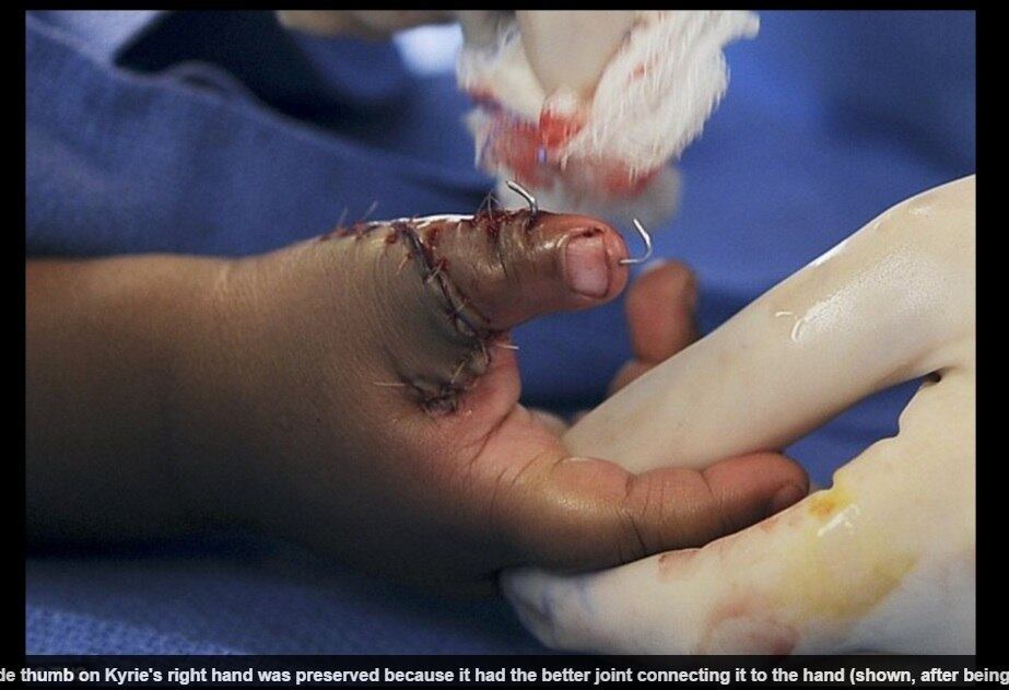 O médico explicou ao Daily Mail que essa é uma condição
embrionária rara: cerca de um em cada 1.000 bebês nasce com dedos adicionais