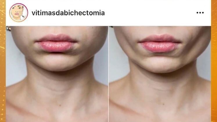 A bichectomia (cirurgia nas bochechas) é um procedimento que virou moda entre os adeptos de intervenções estéticas para mudar o contorno do rosto. Mas, como toda operação que promete melhorar a aparência, há o riscos e as consequências podem ser desastrosas. O Fala Brasil acompanhou o relato de algumas pessoas; saiba mais


