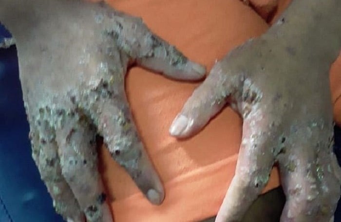 Doença que 'come pele' afetou detentos da Penitenciária Agrícola de Monte Cristo