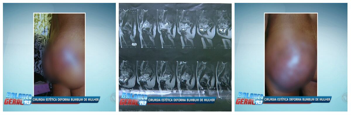 Depois do incidente, Elisangela teve uma série de
problemas: parou de amamentar o filho por falta de leite, teve aumento de varizes e o marido dela começou a
recusar momentos de intimidade. Ela chegou a sofrer infecções.

— Meu marido parou de falar comigo durante alguns dias. No Carnaval, ele viajou com o meu filho e me deixou em casa, com dor
