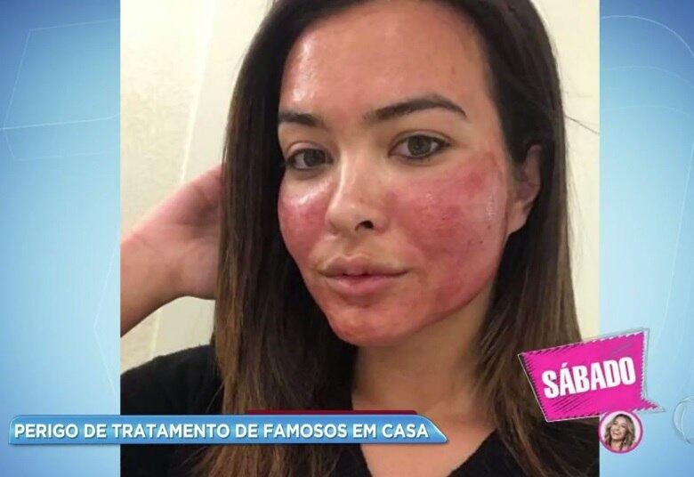 Geisy Arruda, Kim Kardashian e Caroline Bittencourt também aderiram à técnica