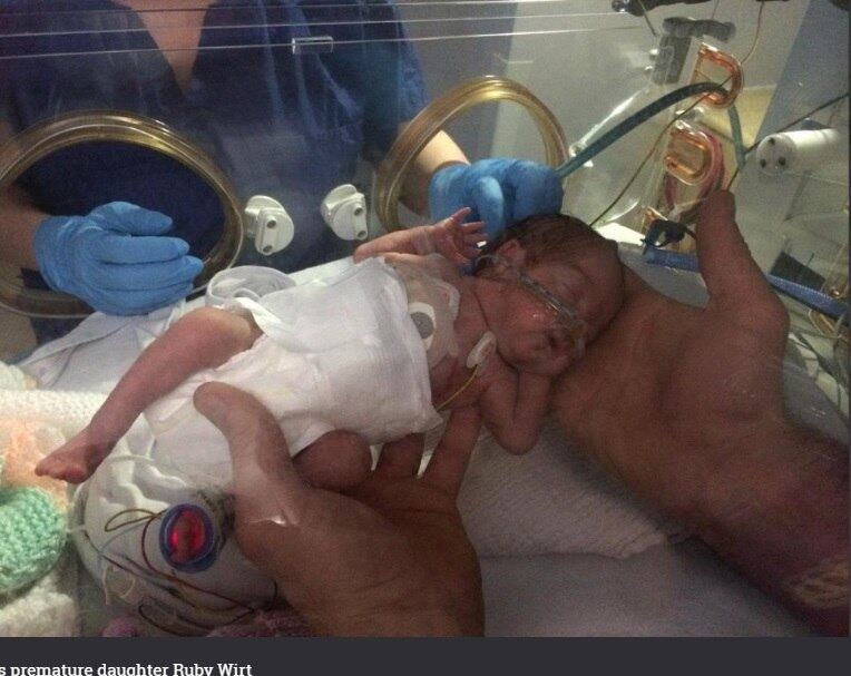 Mãe posta foto de gêmeas que nasceram prematuras com 24 semanas para inspirar outras pessoas. Hoje, aos dois anos de idade, as meninas Sapphire
e Ruby Wirt estão esbanjando saúde. As informações são do jornal britânico The
Sun