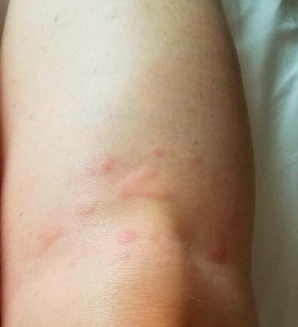 Paciente tomou remédio por três meses, mas voltou a ter urticária quando parou