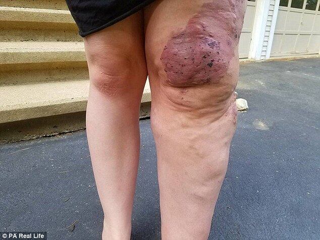 A perna esquerda não é o único membro afetado: o pé, a nádega e até as genitálias podem crescer de forma anormal. A mulher de Boston, Massachusetts, já teve que ser submetida a mais de 60 processos cirúrgicos na tentativa de remover a doença — que ainda é muito desconhecida pelos médicos
