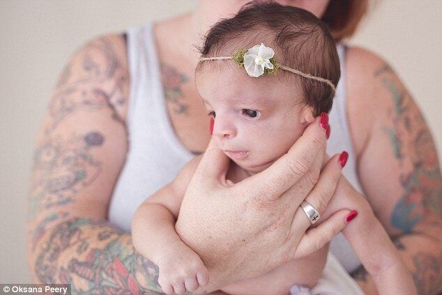 A condição genética fez com que ela não desenvolvesse completamente algumas estruturas de seu rosto, como ossos e tecidos