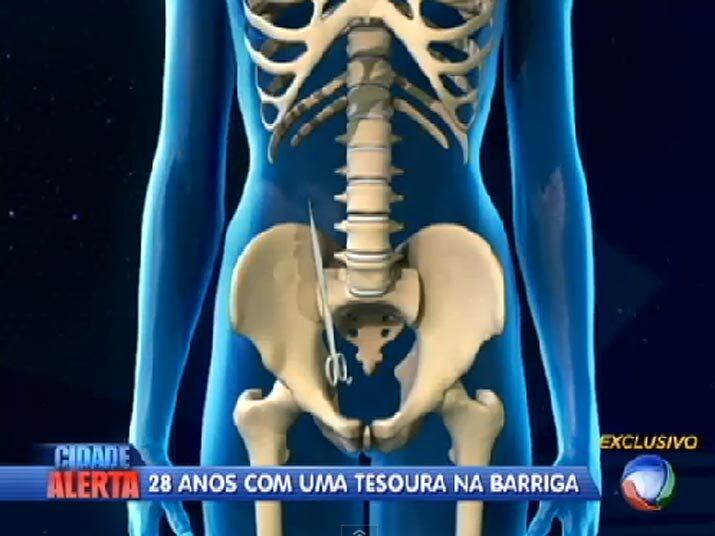 Para recomeçar a viver, dona Sueli foi ao Hospital das Clinicas de São Paulo, onde foi avaliada por uma junta médica, que fez uma bateria de exames para só então decidir se a tesoura poderia ser retirada. Assista ao vídeo!

