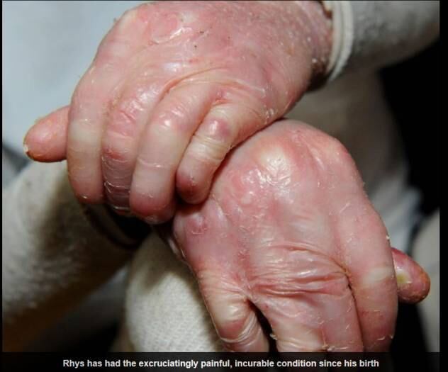 Sua
mãe e cuidadora em tempo integral, Tanya Moors, 30 anos, diz se sentir a pior
mãe do mundo por levar três horas para dar banho em seu filho.
— É
absolutamente traumatizante vê-lo gritando e se contorcendo de dor