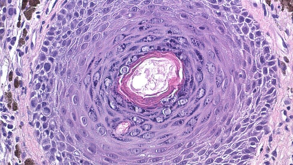 Molécula também será estudada para os cânceres de tireoide, pulmão e pâncreas