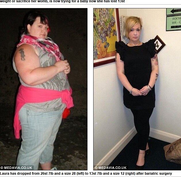 Desde a adolescência, Laura McCullough, 30 anos, sofre de
endometriose. Segundo os médicos, a única maneira de curar a doença e realizar
o sonho da maternidade seria perder peso. Foi por isso que Laura resolveu se
submeter à cirurgia bariátrica. As informações são do site Daily Mail