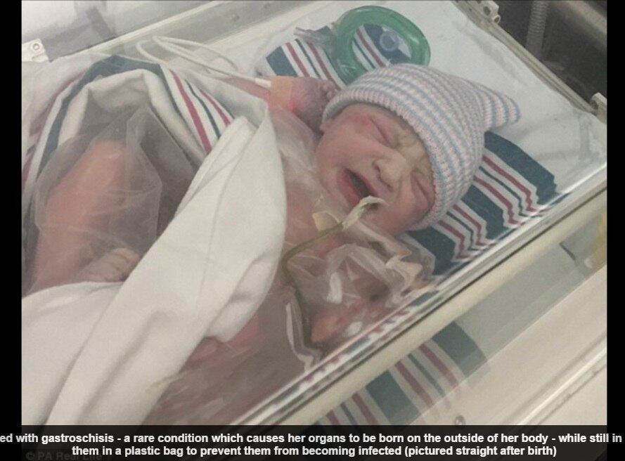 Uma bebê nasceu com os intestinos, estômago, tubas uterinas e ovários para fora de seu corpo e os médicos que cuidaram do parto decidiram proteger os órgãos em um saco plástico porque a cirurgia para colocá-los para dentro não deu certo. As informações são do Daily Mail