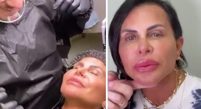 Gretchen se submeteu a procedimentos estéticos nos lábios e nas sobrancelhas