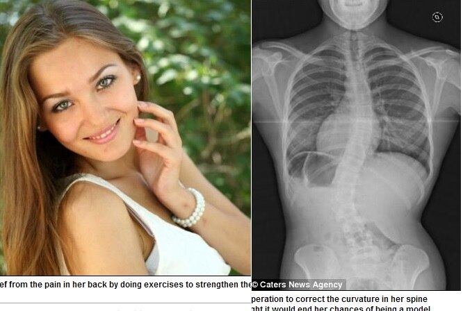 A
adolescente Leanne Roberts, de 18 anos, de Yorkshire,
na Inglaterra, tinha medo de ficar corcunda por causa de uma deformação em sua
coluna. Mas, depois de passar por uma cirurgia, o problema foi resolvido e a adolescente pode realizar o sonho de se tornar
modelo. As informações são do site Daily Mail desta segunda-feira (4)



Ficar muito tempo em pé pode causar problemas nas pernas e na coluna, alerta especialista