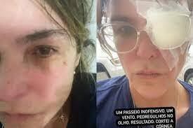 Cristiana Oliveira sofre acidente nos olhos