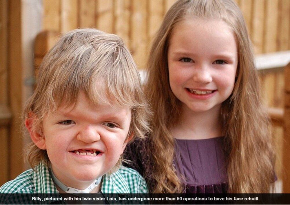 

A mãe relembra que passou por muitas dificuldades desde o
nascimento do seu filho, especialmente enfrentando preconceito de pessoas nas
ruas. Mas com luta e perseverança conseguiu romper obstáculos e, hoje, vibra
com a felicidade do pequeno.

 — As pessoas apontavam para ele na rua. Mas se elas
soubessem o que ele estava passando. Billy já passou por muita coisa, mas eu só
penso no dia em que ele viu seu rosto sem o acessório de ferro e reconstruído.
Acho que se ele pudesse, ele teria dado cambalhotas quando viu. Só temos a
agradecer todos os médicos e enfermeiros

