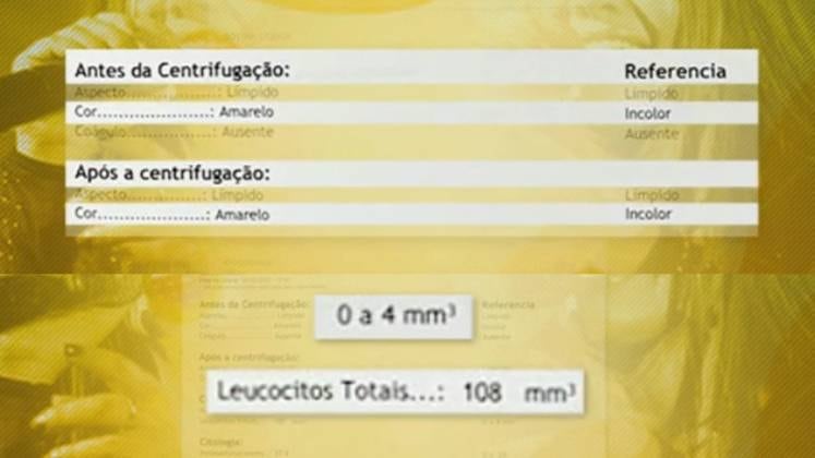 A primeira alteração foi na cor do líquido: de incolor ficou amarelo. Depois, onde não deveria haver células de defesa, tinham várias. Por fim, os índices de glicose e proteína estavam muito elevados
