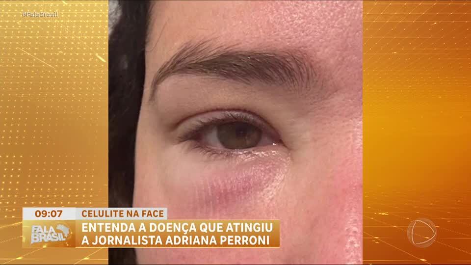 Celulite facial: entenda riscos e sintomas da infecção bacteriana