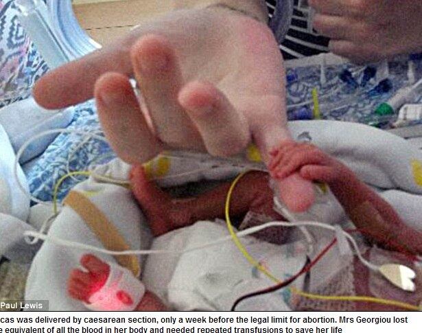 Os pais contam que a mão dele era tão pequena que mal
conseguia segurar o menor dedo de sua mãe.
— Nós o vimos crescer na incubadora. Mas, agora estamos em
êxtase por poder levá-lo para casa. Nosso sentimento de felicidade é muito
maior do que ganhar na loteria
Milagre? Bebê nasce prematuro com 500 g e sobrevive sem sequelas