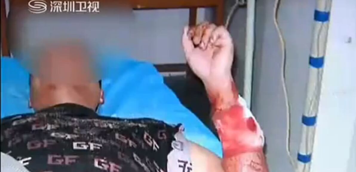 Li, de 27 anos, recebeu atendimento no hospital local
