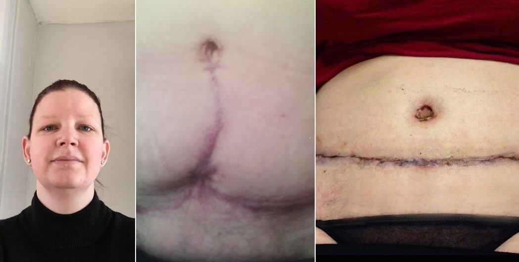 O sonho de ter uma barriga sequinha virou pesadelo para Suzanne Adams, de 39 anos. Após realizar um procedimento de abdominoplastia, na República Tcheca, ela ficou com a barriga deformada e com uma grande cicatriz. As informações são do site Mirror