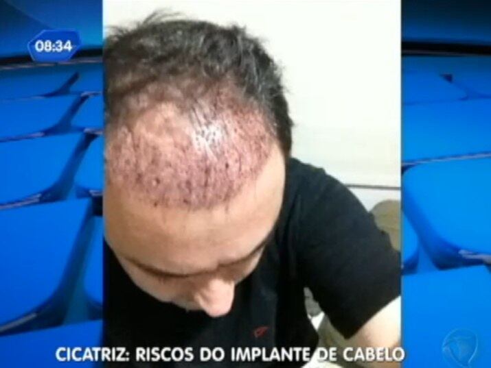 Homens do mundo todo sofrem com a possibilidade da calvície. O ator Paulinho Vilhena confessa que fez uma cirurgia e não teve o resultado desejado. Conheça os
riscos e as vantagens do implante capilar
+ Implante capilar: conheça os riscos do procedimento