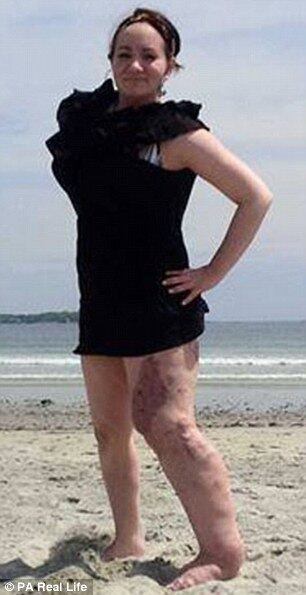 Os médicos afirmaram que a causa da doença não é genética, e que eles não desistiram de encontrar uma cura. A jovem é frequentemente atingida por infecções bacterianas repentinas, isso porque a síndrome é tão incomum e tão desconhecida, que não é possível prever desdobramentos.

— Eu fiquei à beira da morte por 20 vezes