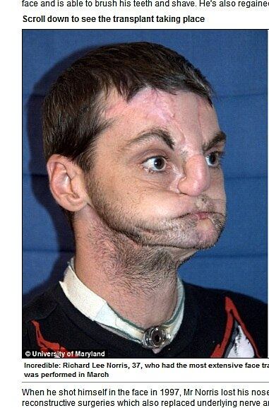 Após o acidente, ocorrido em 1997, Richard perdeu o nariz, os lábios e o movimento em sua boca. Por 15 anos, o rapaz viveu se escondendo atrás de máscaras e só saia à noite